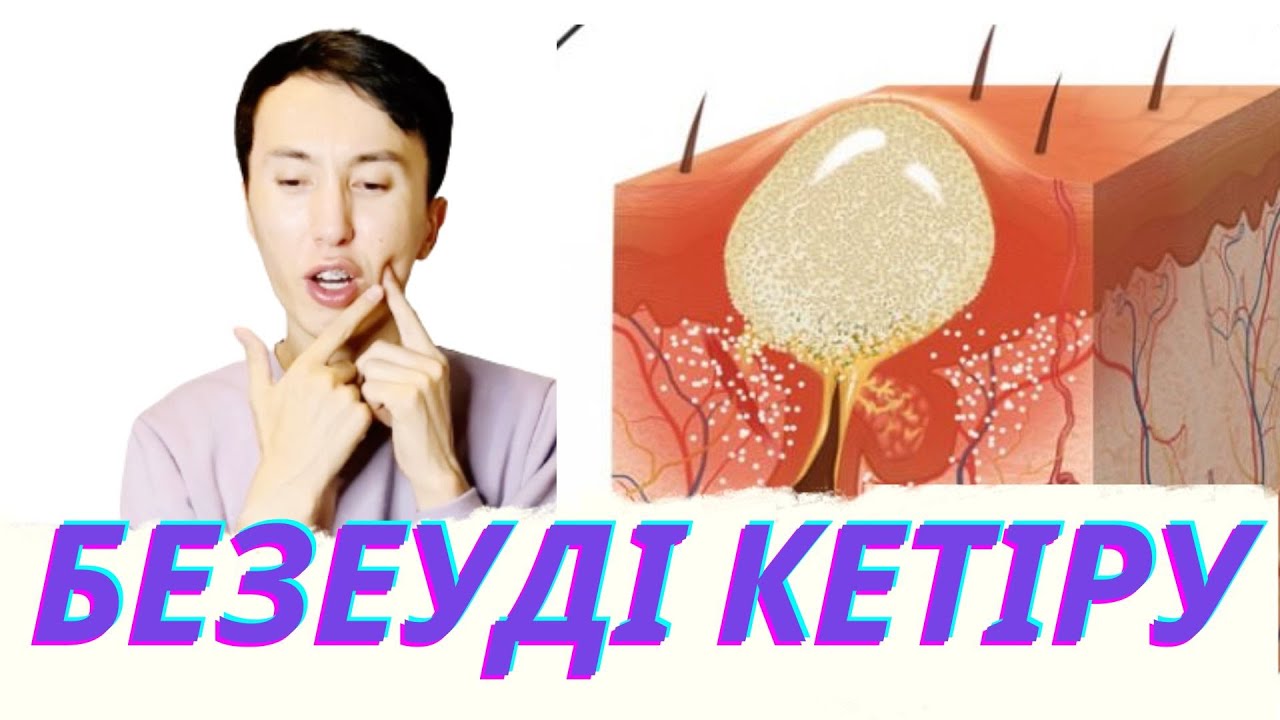 Безеуді қалай кетіру керек?
