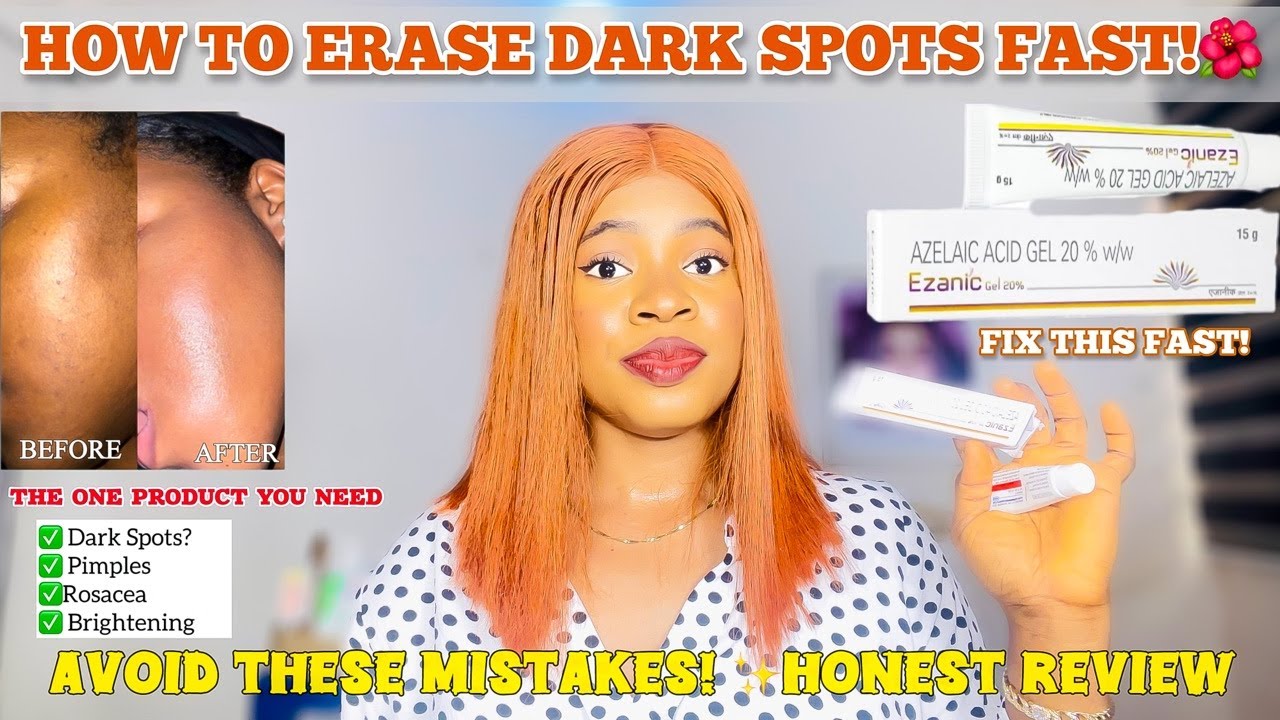 HOW TO GET RID OF DARK SPOTS WITH AZELAIC ACID GEL | Honest Review & Fast Results! +Easy Application