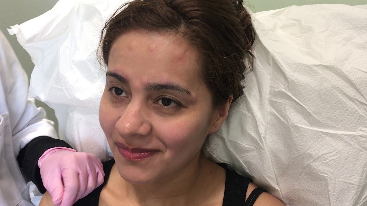 Under-Eye Restylane Filler Injections