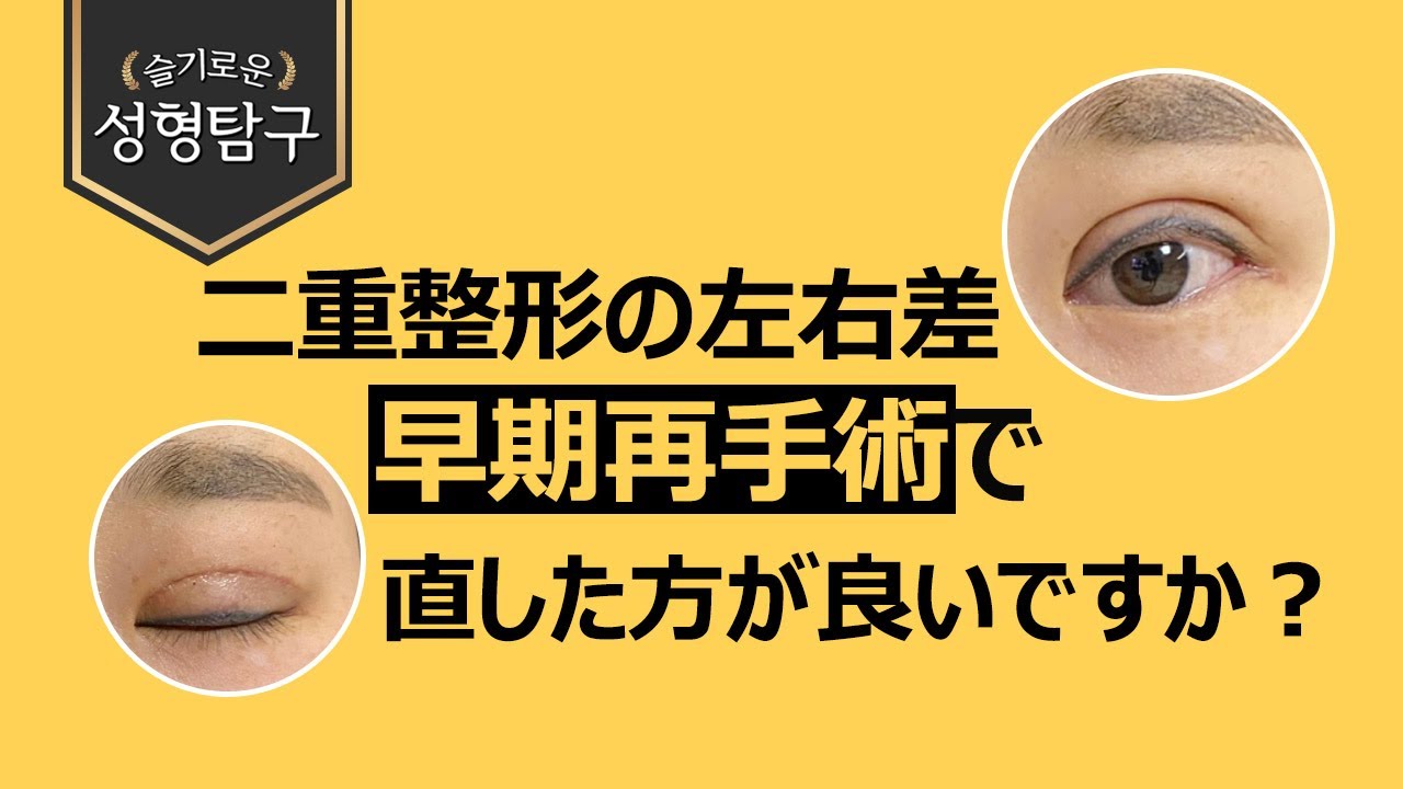 二重整形後に左右差と不自然過ぎて気になる、早期再手術で修正した方がいいですか？