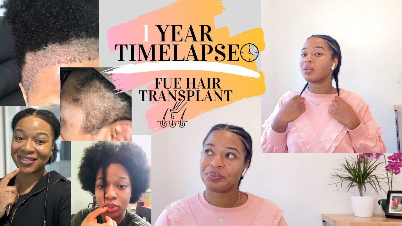 1 Year Time-lapse of my FUE Hair Transplant| Natural Hair