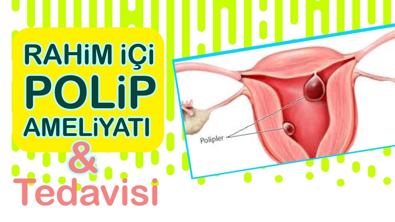 Polip Nedir? Rahim İçi Polip Ameliyatı ve Tedavisi Hakkında Merak Edilenler - Prof. Dr. Gamze Sinem