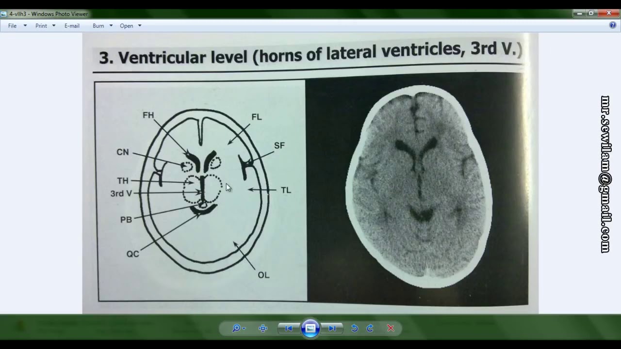 شرح الأشعة المقطعية على الرأس CT scan, Head د  محمود سويلم