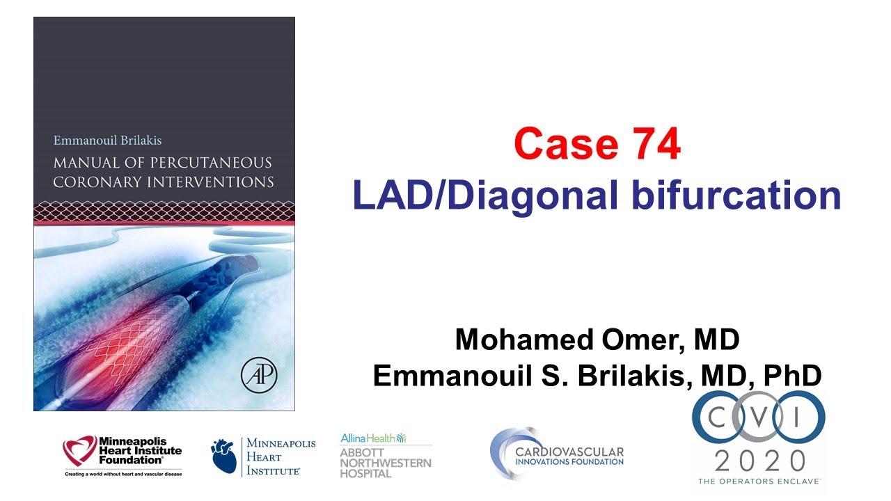 Case 74: PCI Manual - LAD/diagonal bifurcation