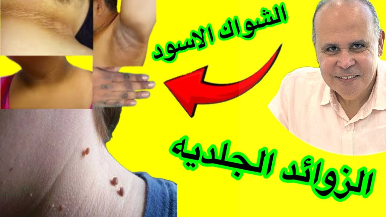 علامات خطيره في الجلد لمقاومه الانسولين  والسرطان..الشواك الاسود والزوائد الجلديه