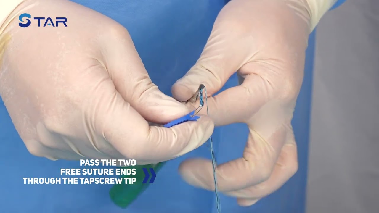 STAR Self-Punching PEEK Suture Anchors (ExtraLock and TapScrew) - Drybone User Guide