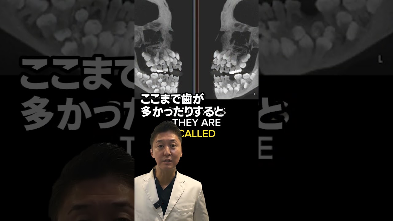 過剰歯と呼ばれるものです😶 #歯列矯正 #蒲田 #歯医者 #矯正 #dentist