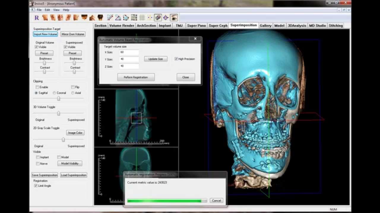 4D Superimposition with Pre and Post Orthognathic Surgery CBCT Scans