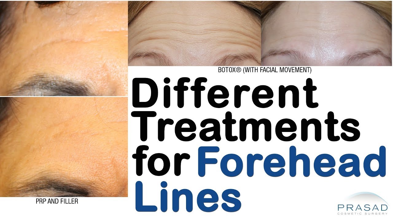 How Forehead Lines and Wrinkles can be Treated With or Without Surgery