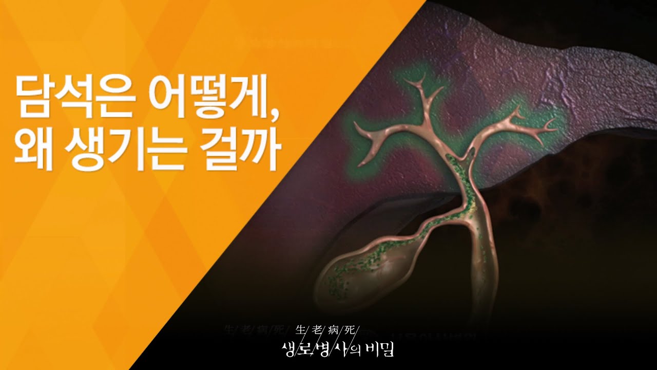 담석은 어떻게, 왜 생기는 걸까 - (2011.4.16_369회 방송)_내 몸에 위험한 돌이 자란다 - 결석, 담석