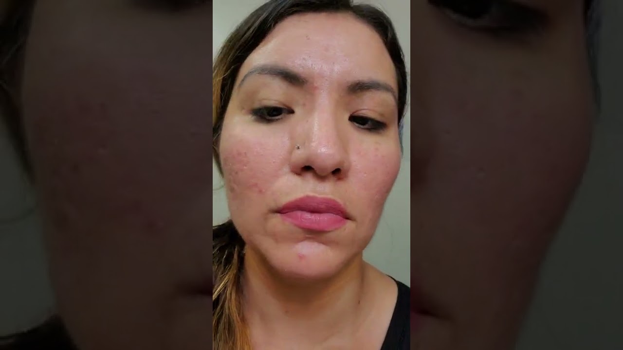#biooil #acne #scars          first week with using biooil.
