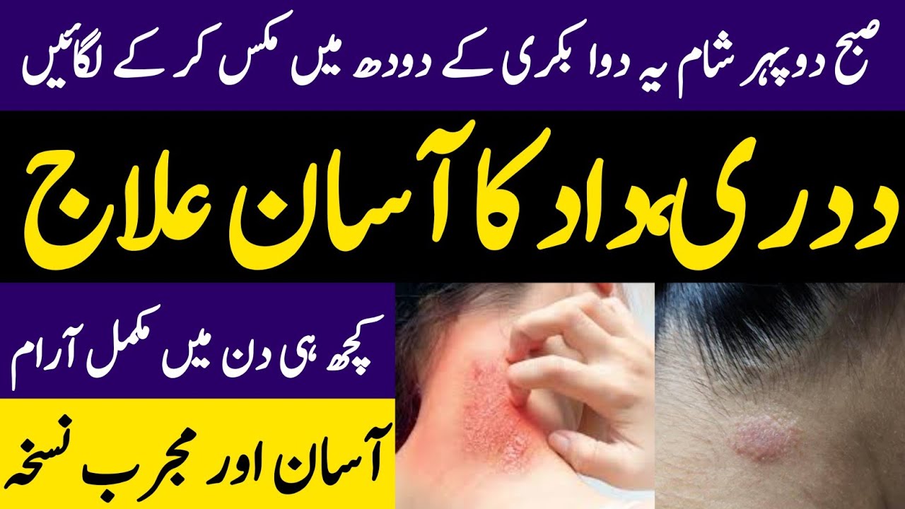 How To Remove Fungal Infection || Dadri , Dad Ka ilaj || Hakeem Zia Shahid