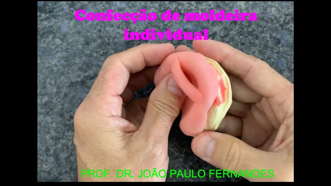 6 - Confecção de Moldeira individual superior