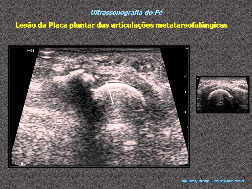Foot ultrasound - metatarsophalangeal plantar plate injury