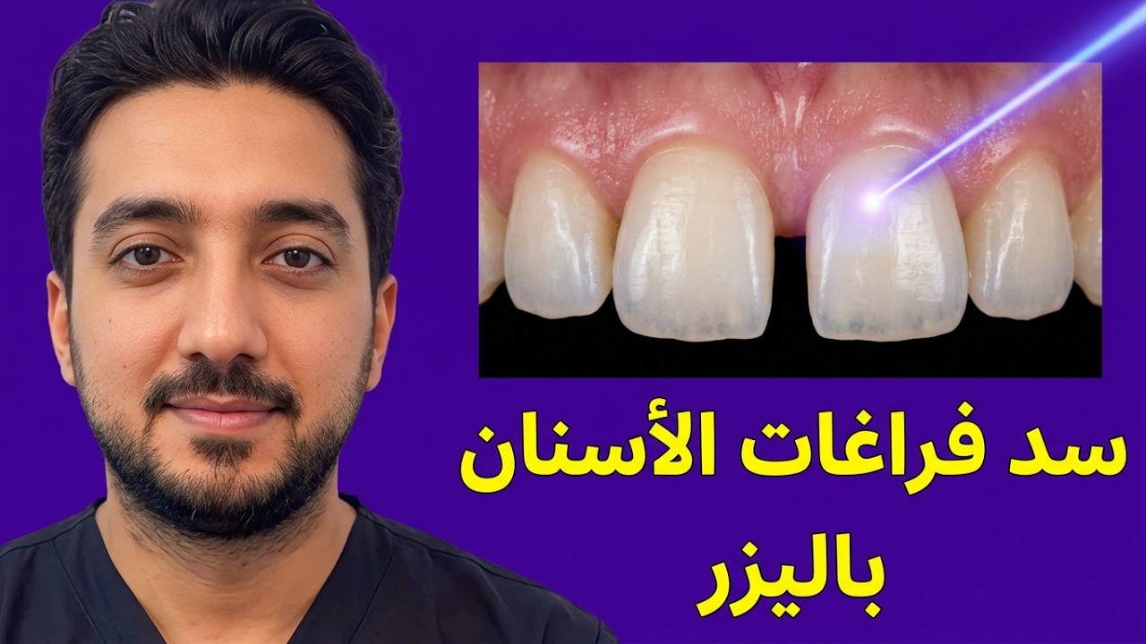 Advantages and Disadvantages of Closing Teeth Gaps with Laser Fillings (Composite)