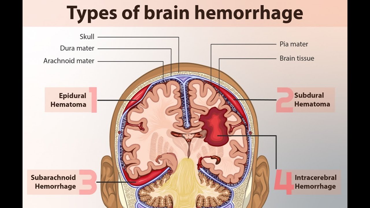 3.Magdy Said,clinical anatomy, intracranial haemorrahge