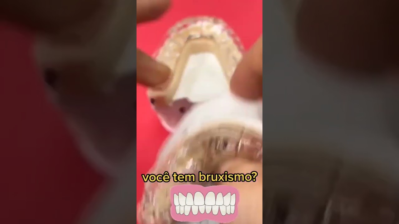 placa para bruxismo #dentista #bruxismo #drmarcosviniciuss
