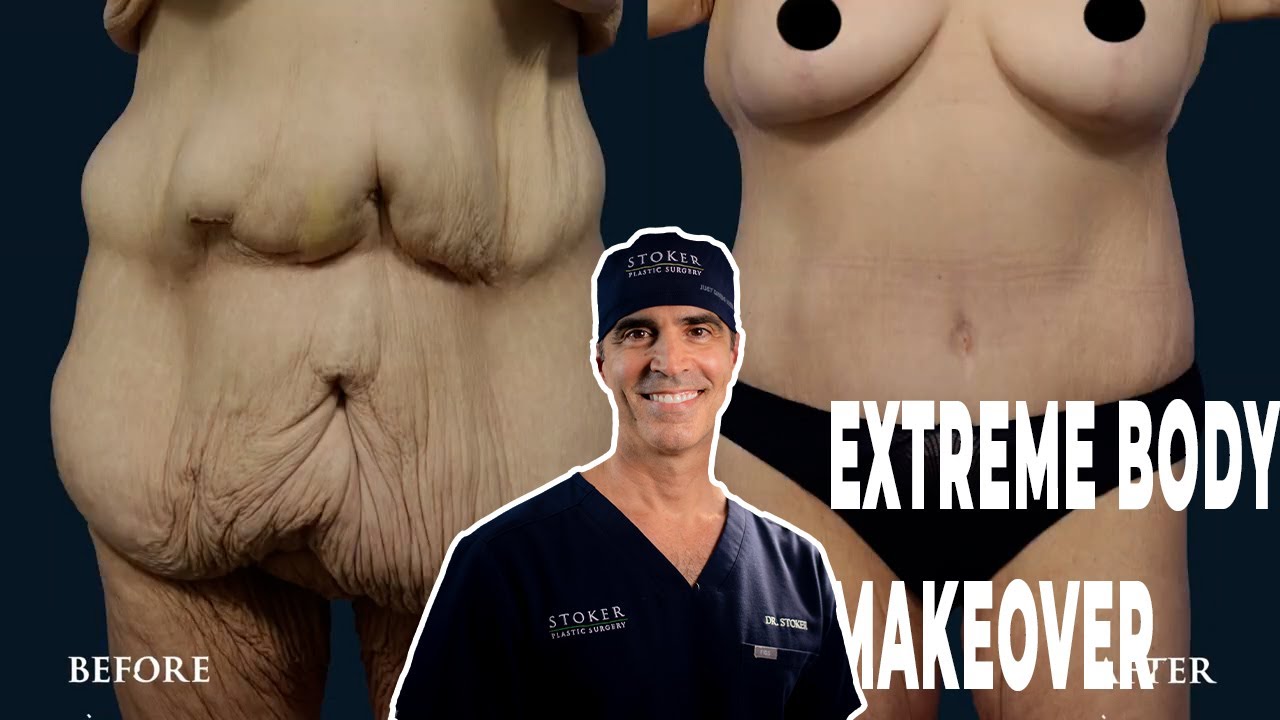 UPPER AND LOWER BODY LIFT | DR. DAVID STOKER | LOS ANGELES