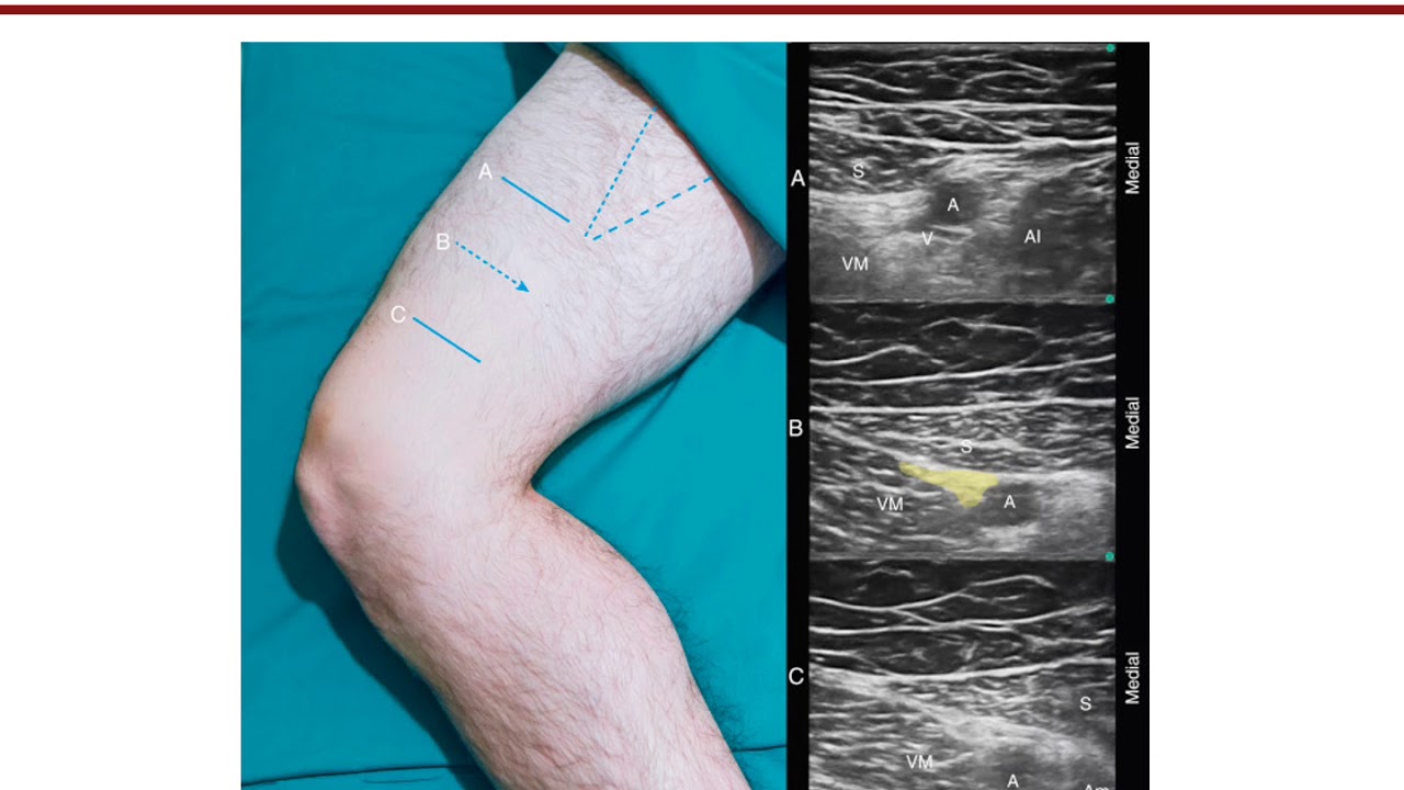 Adductor Canal Nerve Block.mp4