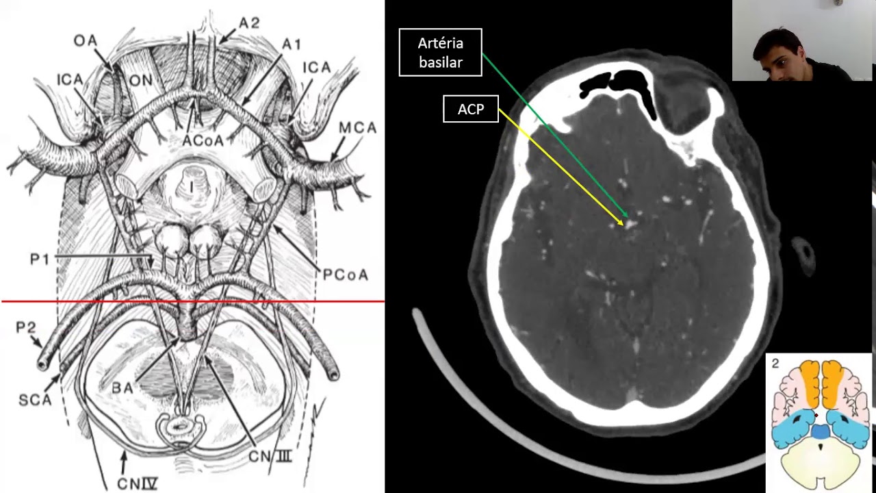 Neuroanatomia aplicada à angioTC de crânio