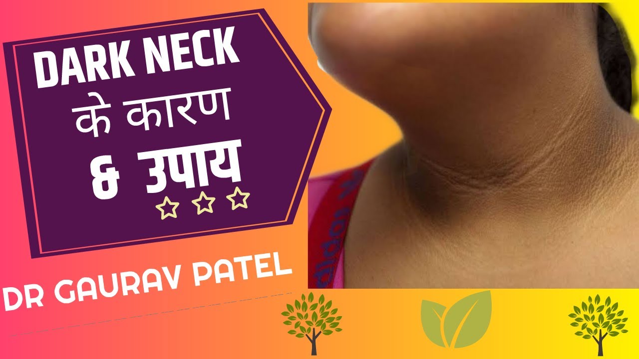 Dark neck- causes and treatment