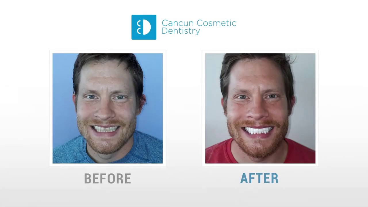 Check out his BEFORE AND AFTER SMILE MAKEOVER!