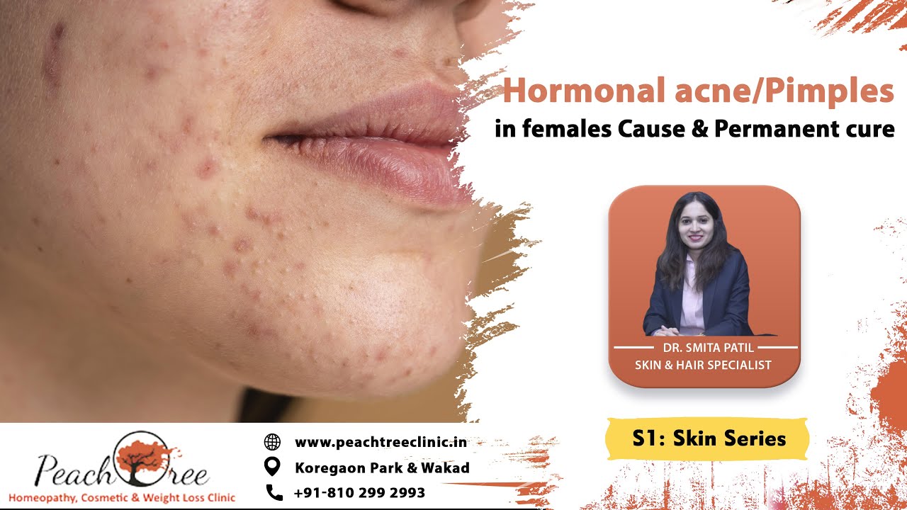 Hormonal Acne / Pimples in females - Cause & permanent cure