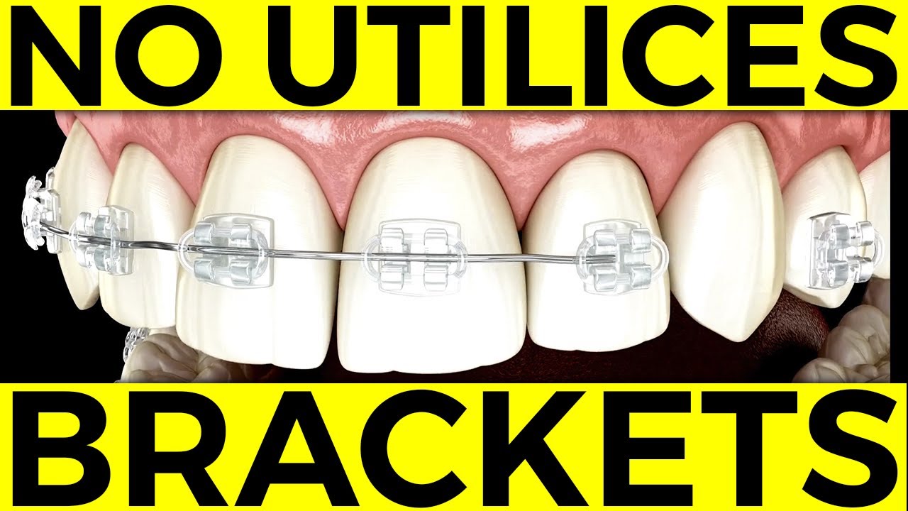 ¿Cómo EVITAR usar BRACKETS para CORREGIR dientes chuecos? Estos son los Beneficios de la ORTOPEDIA