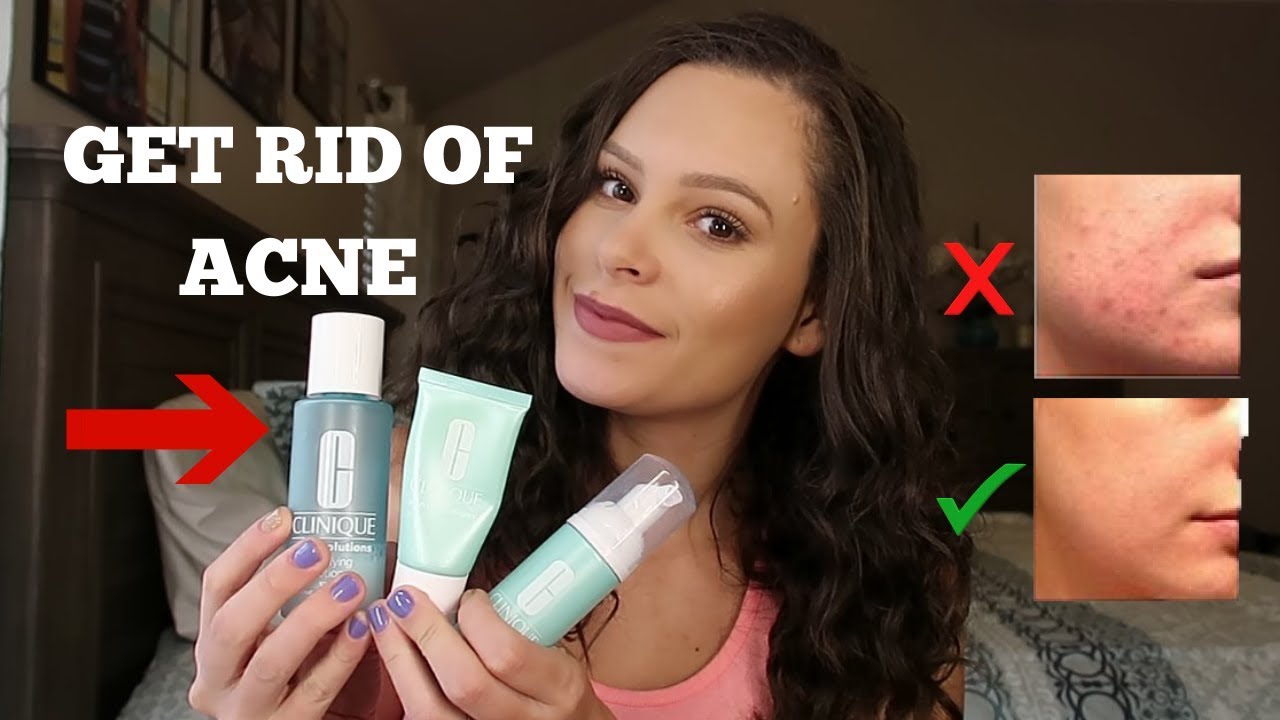 SECRET TO CLEARING UP MY ACNE! HOW TO GET RID OF ACNE FAST!