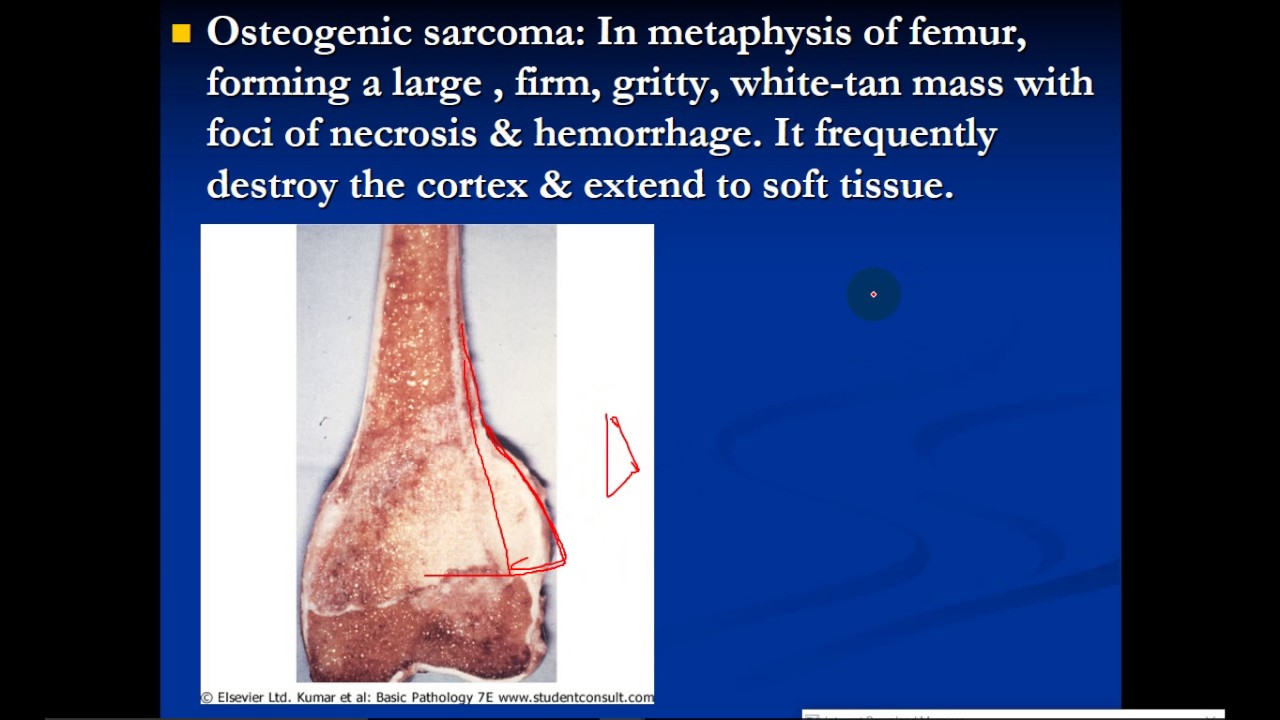 patho - Dr. Dhaymaa -- Bone Tumors