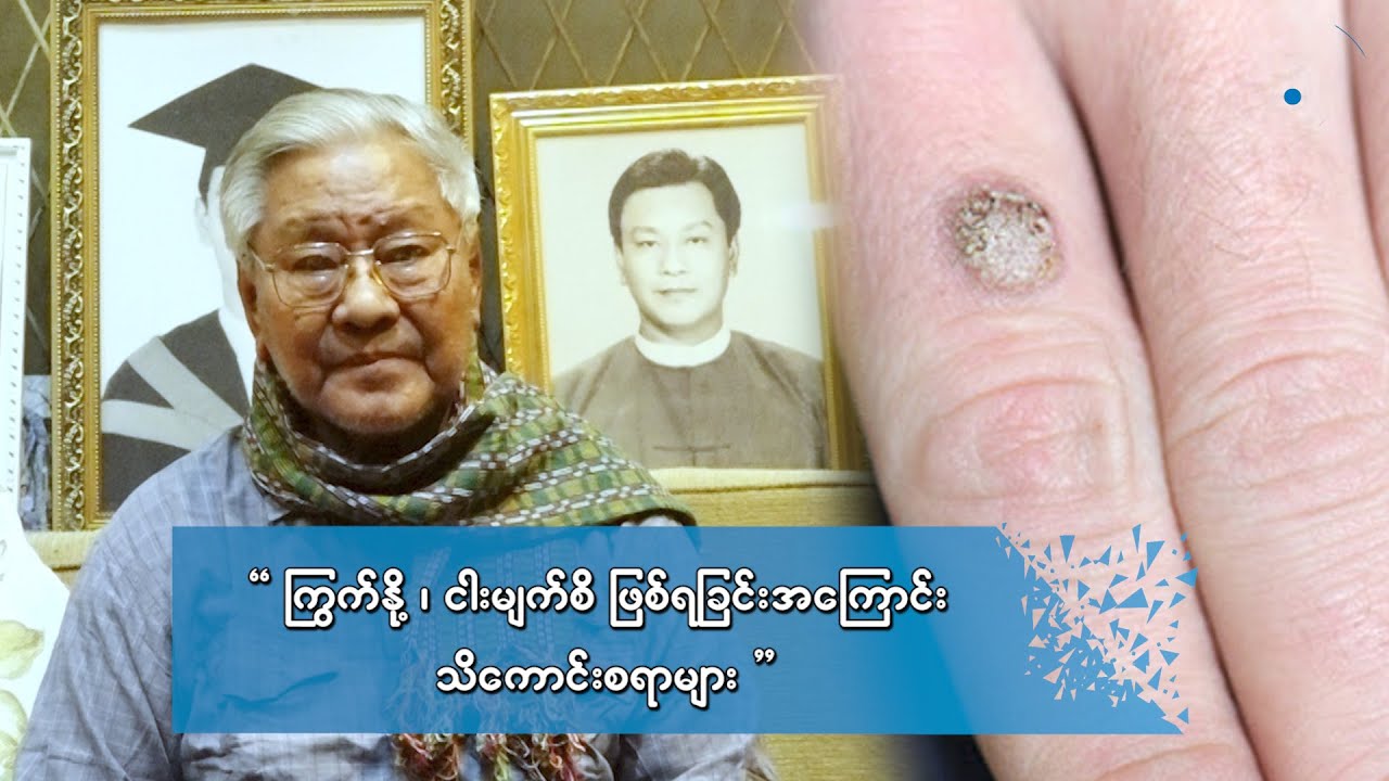 ကြွက်နို့၊ ငါးမျက်စိ ဖြစ်ရခြင်းအကြောင်း သိကောင်းစရာများ