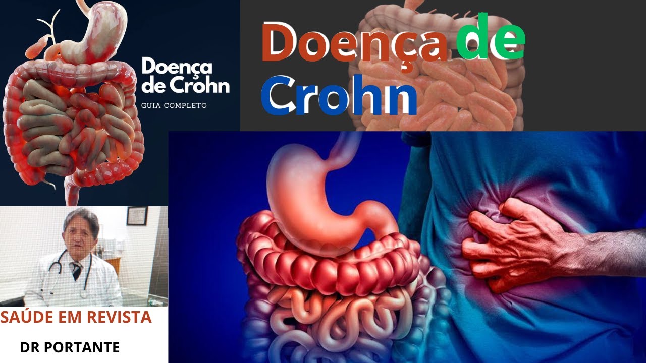 67º SAÚDE EM REVISTA   DOENÇA DE CROHN