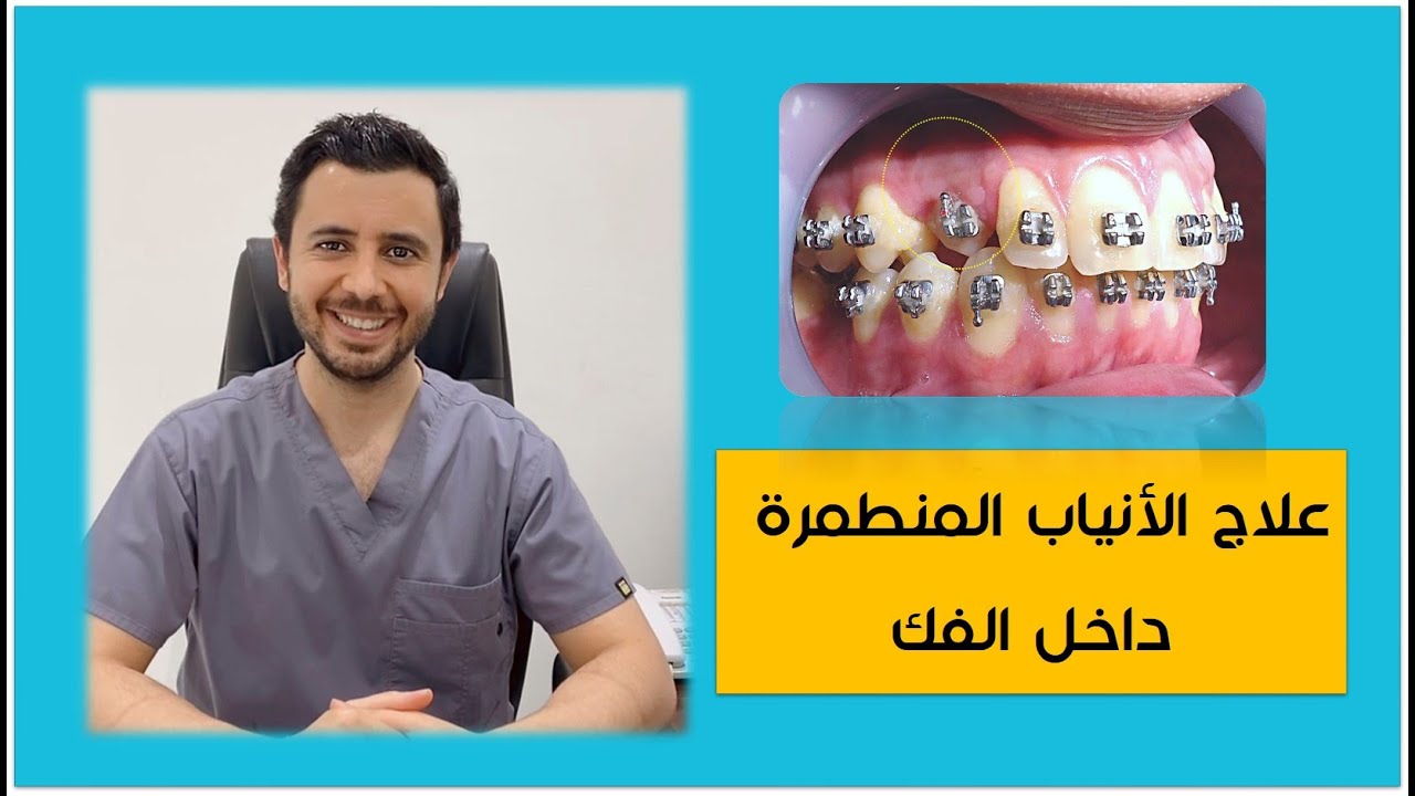 سحب الأنياب المنطمرة داخل الفك مع تقويم الأسنان الثابت المعدني
Treating impacted canine with braces.