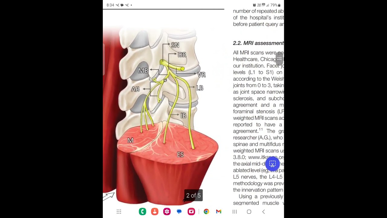 Exciting research about Low Back Pain. Radiofrequency Ablation undeniably damages multifidus muscle.