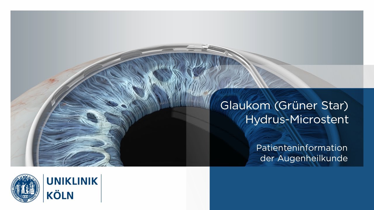 Glaukom (Grüner Star) – Hydrus-Microstent (Patienteninformation Augenklinik) | Uniklinik Köln.