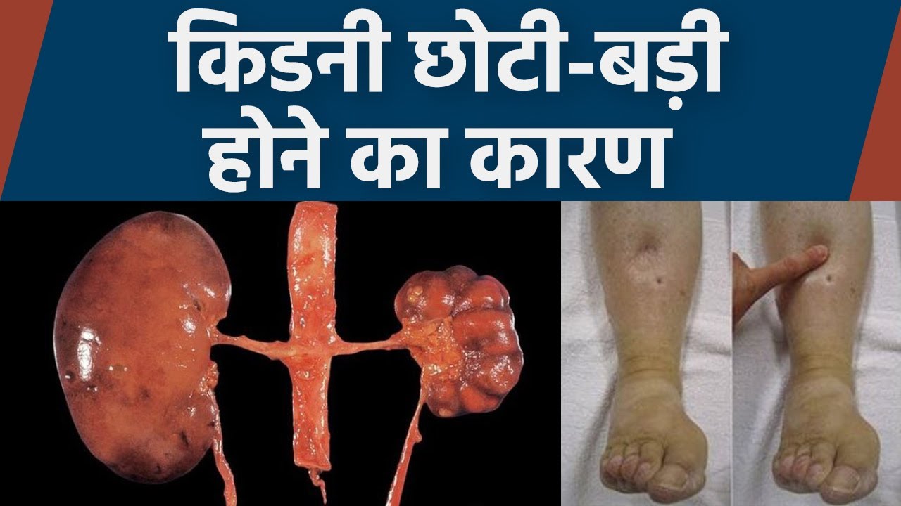 किडनी छोटा बड़ा होने से क्या होता है। किडनी  छोटा बड़ा होने का कारण।  Boldsky*Health