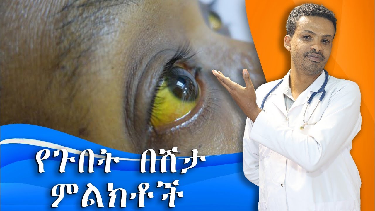 የጉበት በሽታ ህክምና | Hepatitis A,B,C | ዶ/ር ሰይፈ | Dr. Seife
