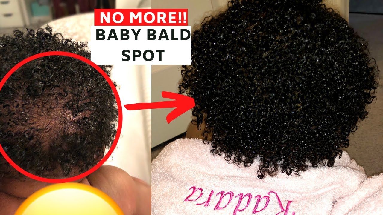 REGROW that baby bald spot FAST! Guaranteed Results every-time!