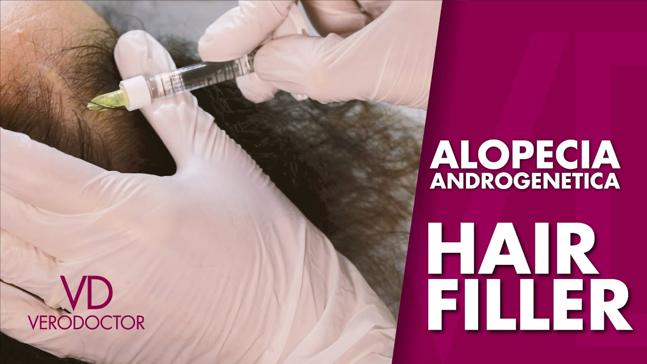 VERODOCTOR #3 - ALOPECIA ANDROGENETICA - HAIR FILLER