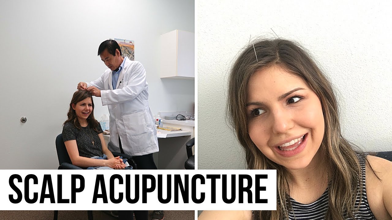 Scalp Acupuncture + New Mexico Trip