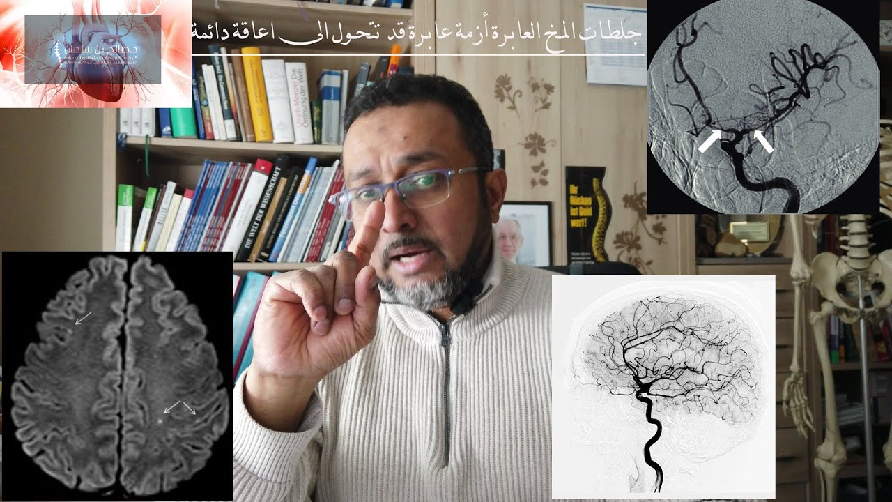 جلطات المخ العابرة، حالة عابرة قد تؤدي الى اعاقة دائمة
