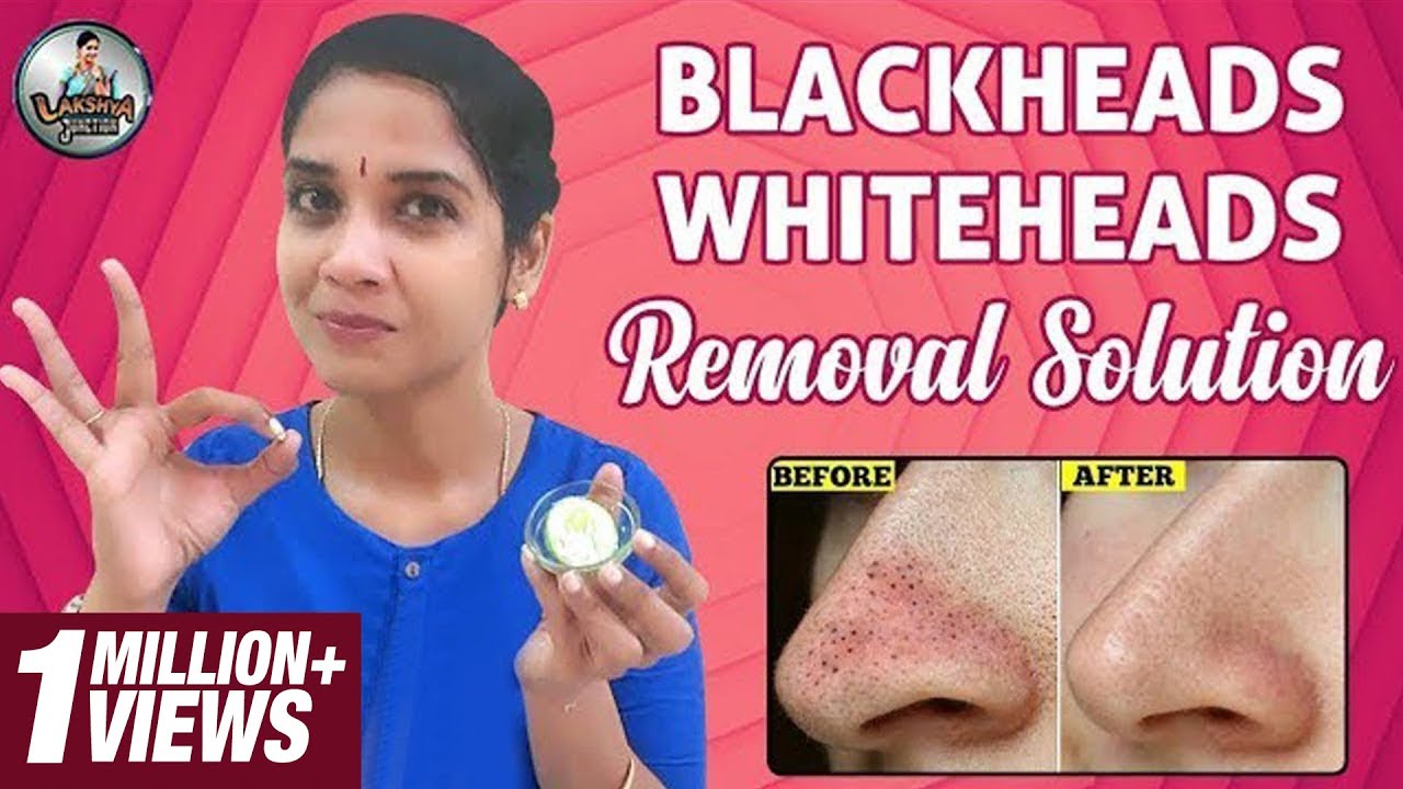 Blackheads Whiteheads | Homemade Removal Solution | Lakshya Junction