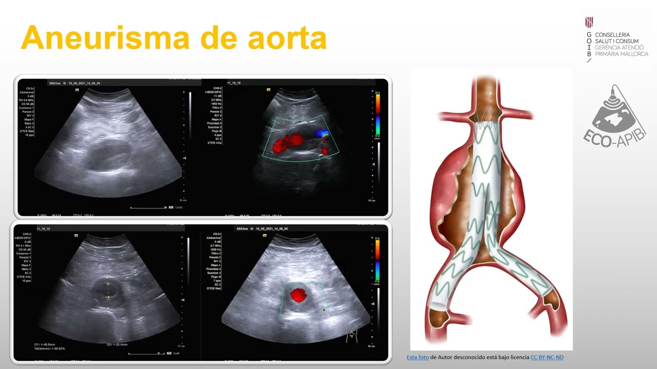 Ecografía clínica vascular básica parte I : Aorta y TVP  Dra Nieves Mendieta 2023  mp4