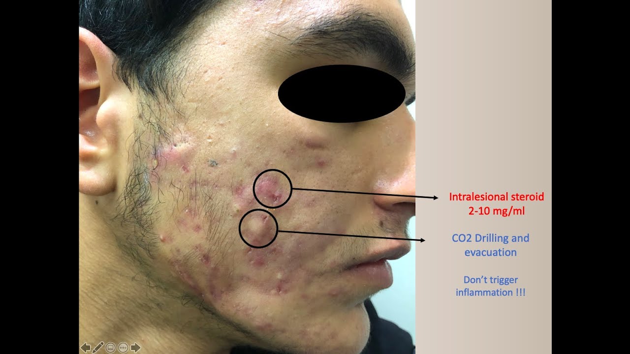 CYSTIC ACNE MANAGEMENT
