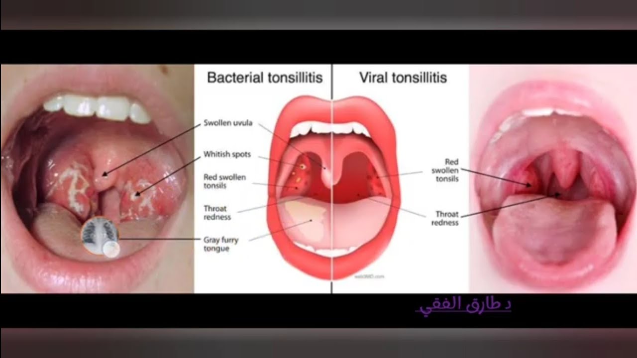 Nursing care of the respiratory system diseases in pediatrics | part 1 | د طارق الفقي 