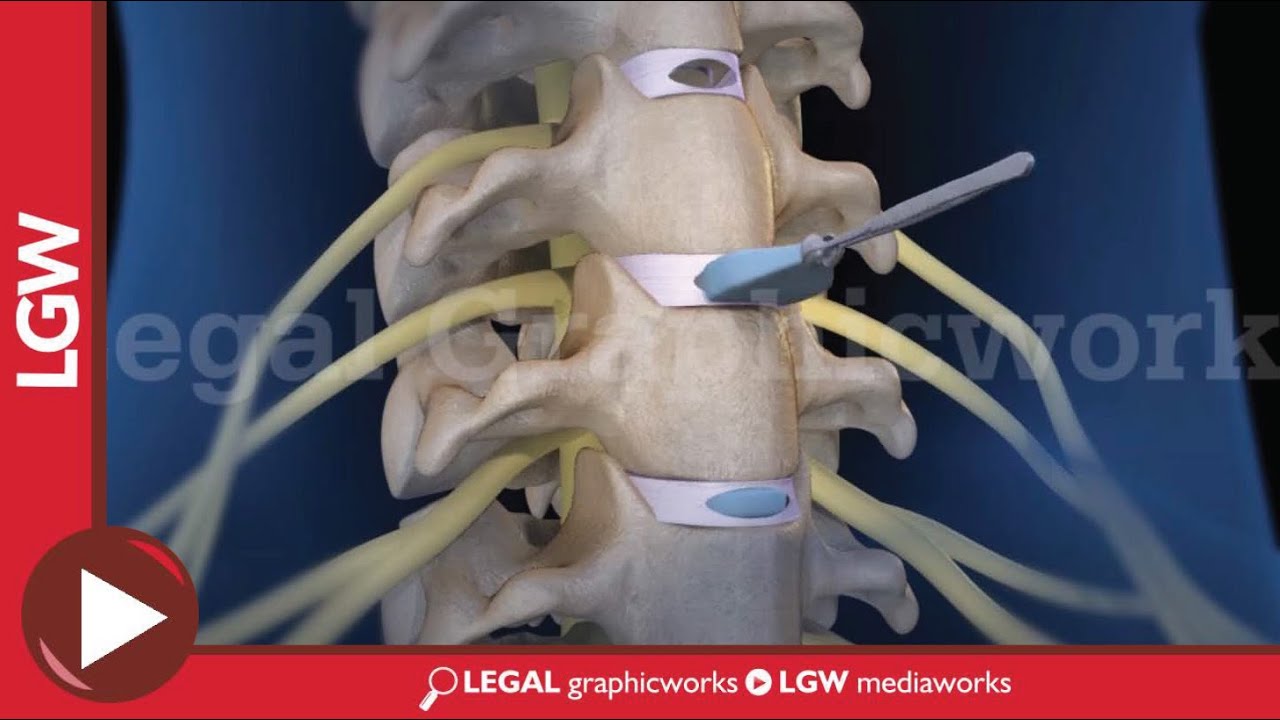 Cervical Discectomy & Fusion Surgery 3D animation C3 C4 C5 C6