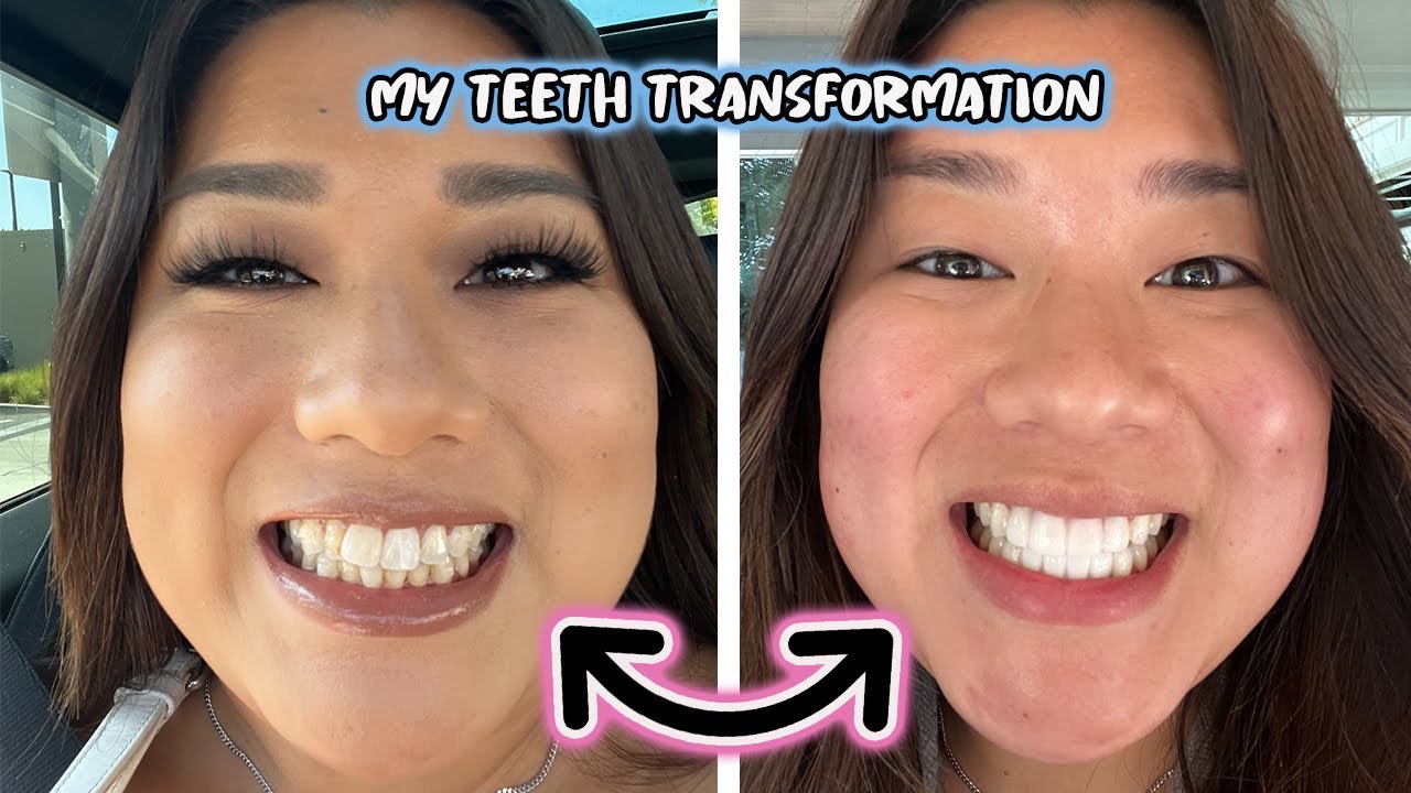 MY NEW TEETH!! teeth transformation + veneers experience!!