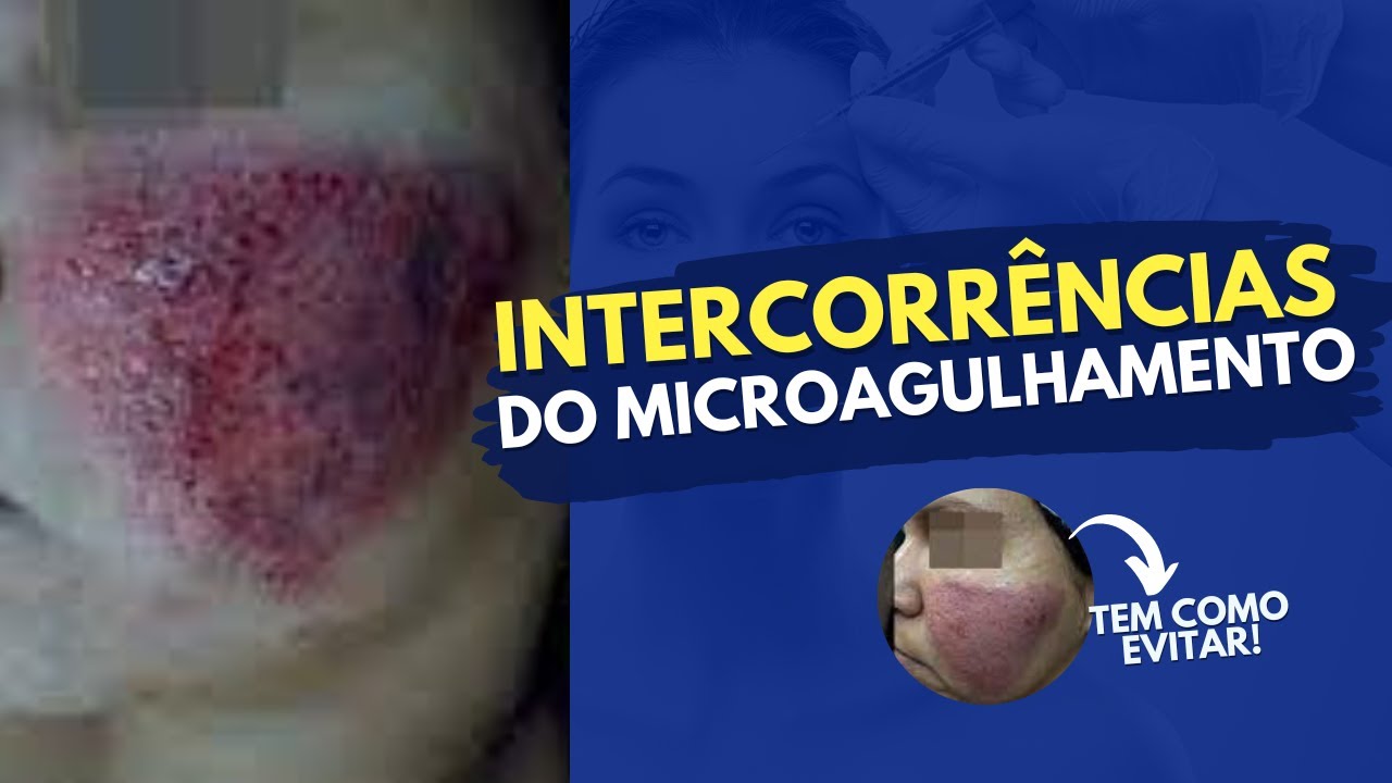 INTERCORRÊNCIAS COM MICROAGULHAMENTO - ENTENDA