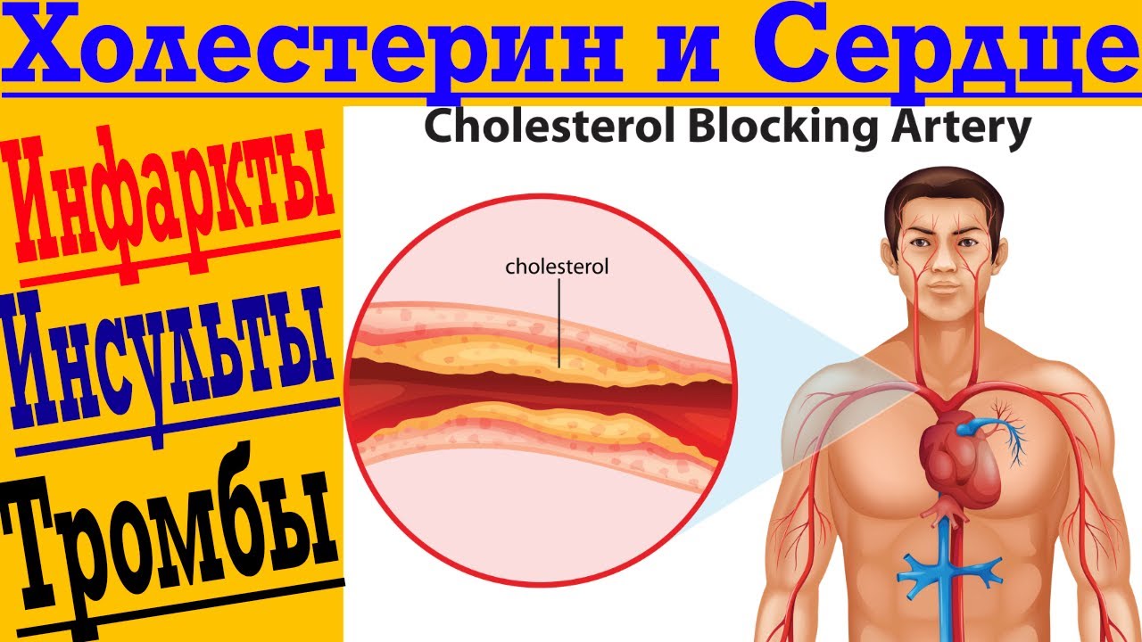 Холестерин и Сердце! Инфаркты, инсульты, тромбы и атеросклероз !