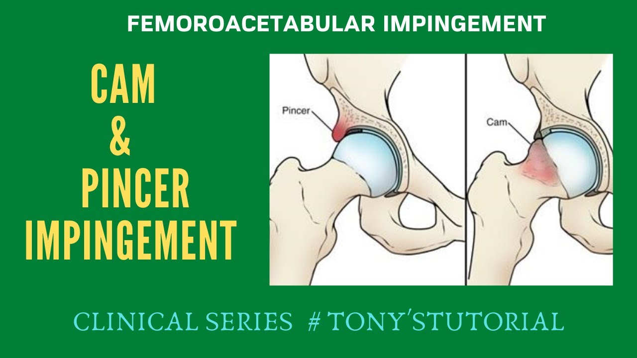 FEMEROACETABULAR IMPINGEMENT# Cam & Pincer Impingement